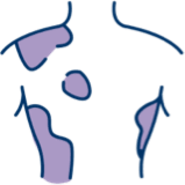 graphic of person with psoriasis on torso person with psoriasis graphic